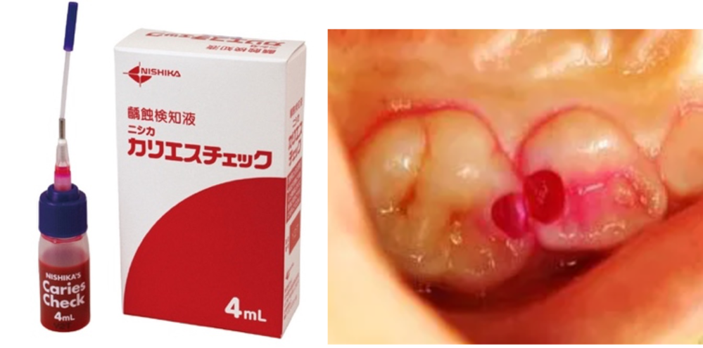 う蝕検知液を使用した丁寧な治療